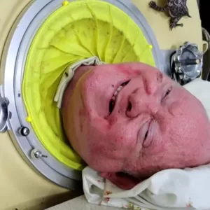 The Last U.S. Man Living In an Iron Lung Has Died