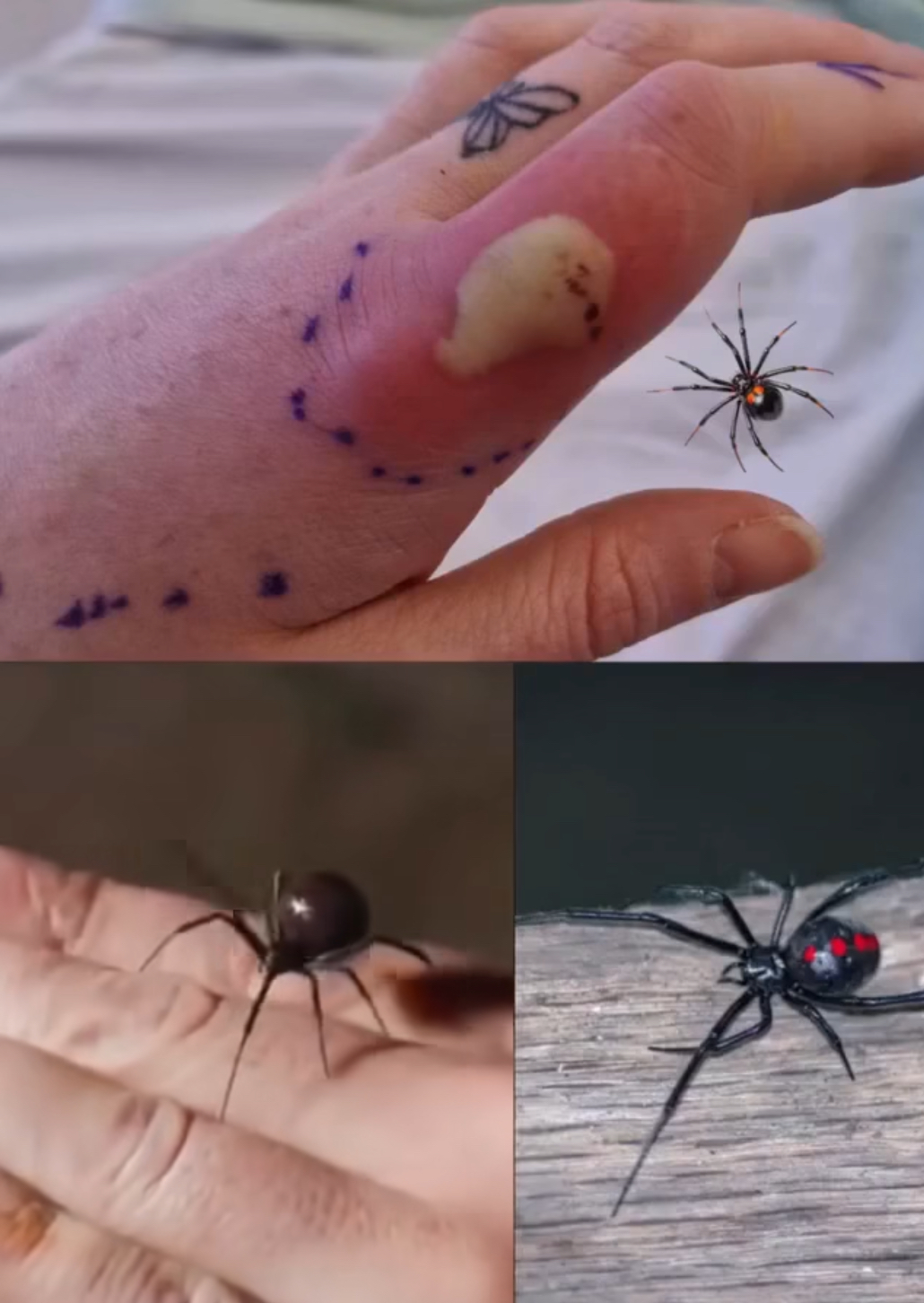 What to do if you get bit.ten by a black widow spider: A complete guide